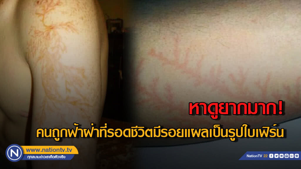 หาดูยากมาก! คนถูกฟ้าฝ่าที่รอดชีวิตมีรอยแผลเป็นรูปใบเฟิร์น หาดูยากมาก! คนถูกฟ้าฝ่าที่รอดชีวิตมีรอยแผลเป็นรูปใบเฟิร์น