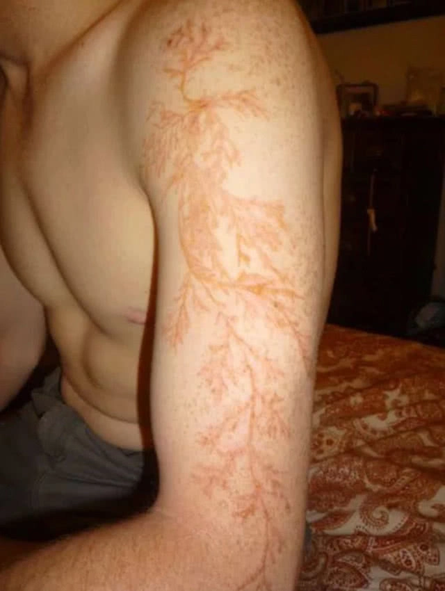 หาดูยากมาก! คนถูกฟ้าฝ่าที่รอดชีวิตมีรอยแผลเป็นรูปใบเฟิร์น