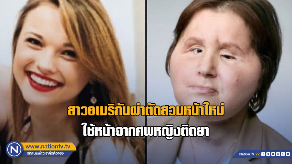 สาวอเมริกันผ่าตัดสวมหน้าใหม่ ใช้หน้าจากศพหญิงติดยา