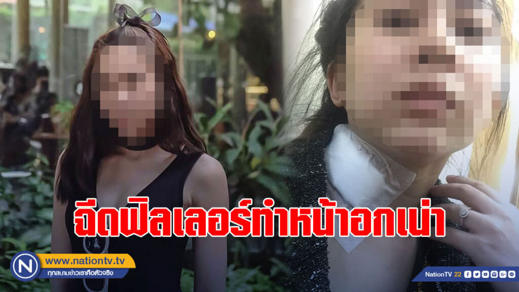 อุทาหรณ์ทรมานเกือบตาย! สาวฉีดฟิลเลอร์ทำหน้าอกเน่า