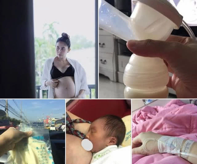 อุทาหรณ์ทรมานเกือบตาย! สาวฉีดฟิลเลอร์ทำหน้าอกเน่า