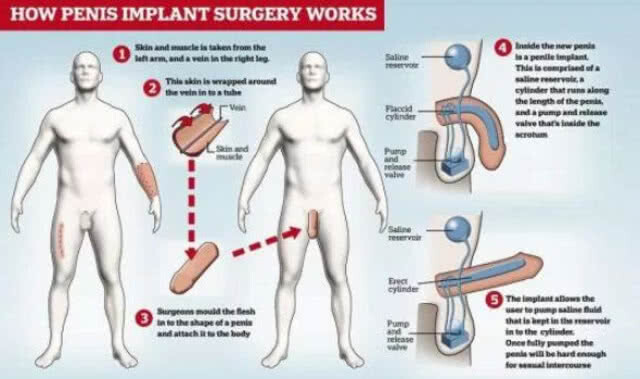 ชายอังกฤษเพิ่งเสียพรหมจรรย์ตอนอายุ 45 หลังการผ่าตัดปลูกเจ้าโลกเทียม