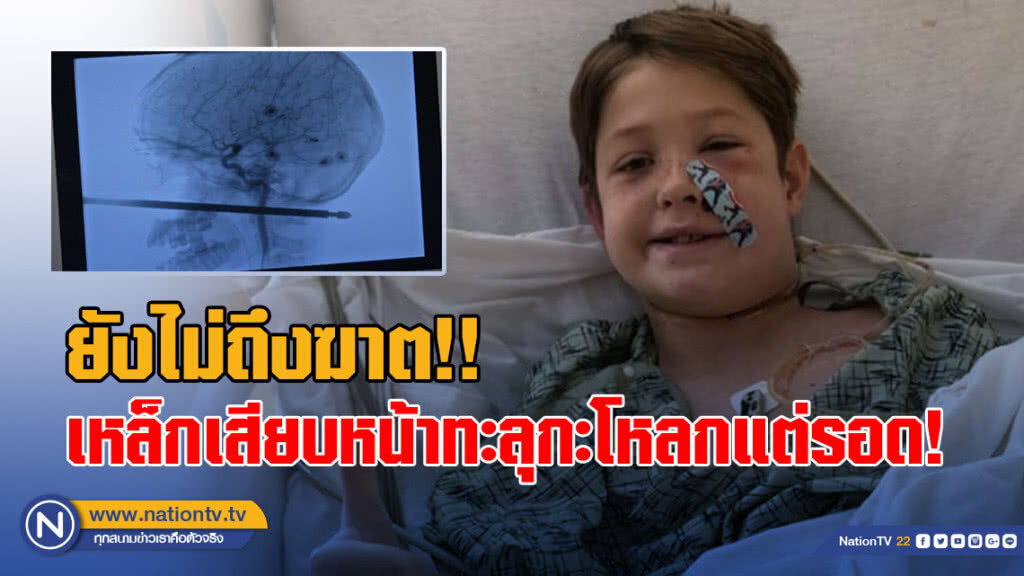 1ในล้าน! เด็ก10ขวบถูกเหล็กแทงหน้าทะลุกะโหลกแต่รอด! 1ในล้าน! เด็ก10ขวบถูกเหล็กแทงหน้าทะลุกะโหลกแต่รอด!