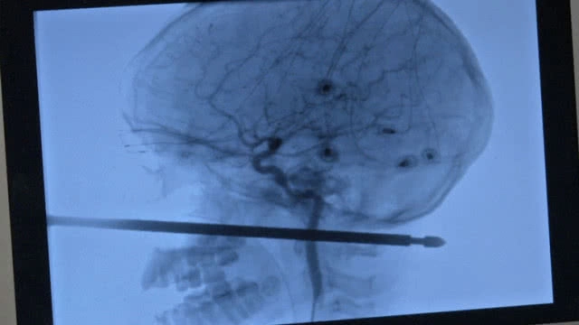 1ในล้าน!  เด็ก10ขวบถูกเหล็กแทงหน้าทะลุกะโหลกแต่รอด!