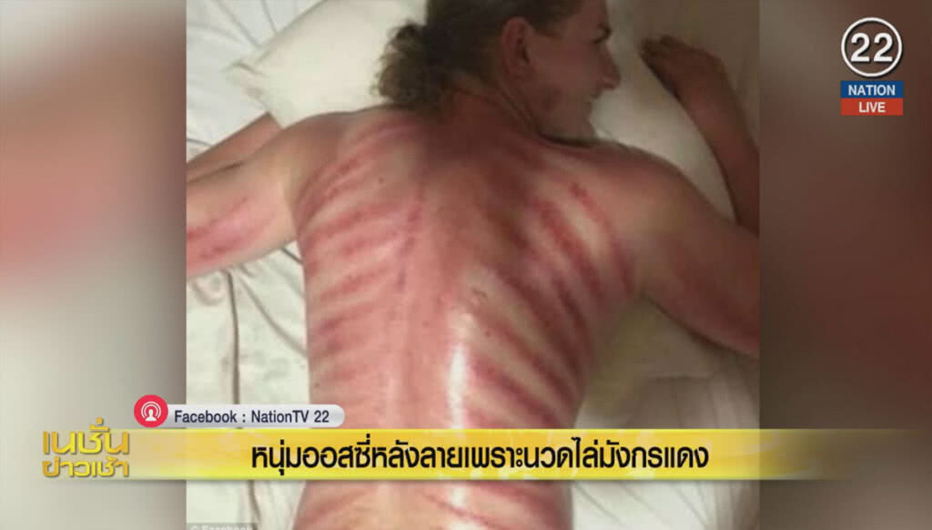 (คลิปข่าว) หนุ่มออสซี่หลังลาย เพราะนวดไล่มังกรแดง (คลิปข่าว) หนุ่มออสซี่หลังลาย เพราะนวดไล่มังกรแดง