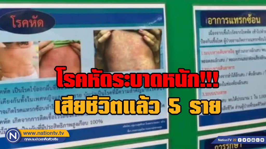 สสจ.ยะลา โรคหัดระบาดหนัก!!! เสียชีวิตแล้ว 5 ราย