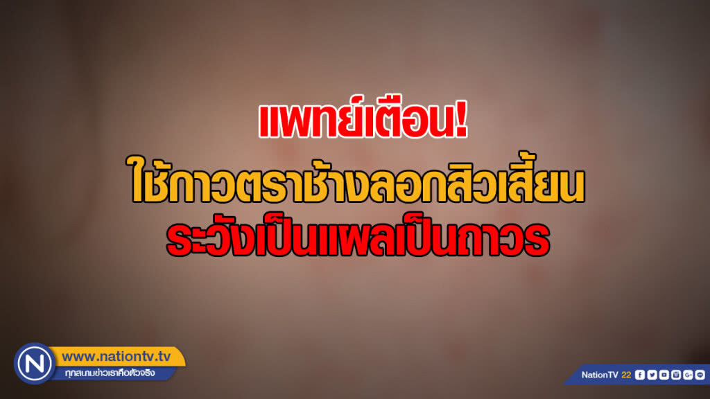 เตือนใช้กาวตราช้างลอกสิวเสี้ยน ระวังเป็นแผลเป็นถาวร