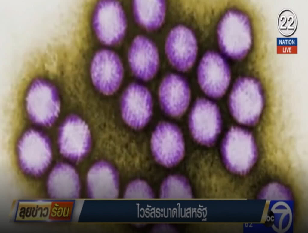 (คลิปข่าว) ไวรัสระบาดในสหรัฐ เด็กเสียชีวิต 6 และอีก 12 คนติดเชื้อ