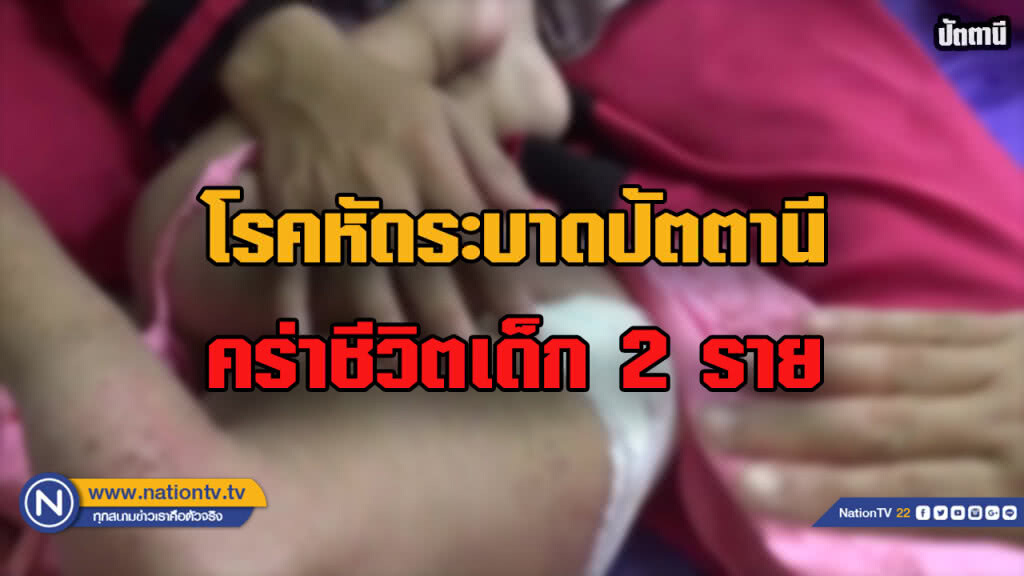 โรคหัดระบาด! เด็กปัตตานีเสียชีวิต 2 ติดเชื้ออีก 300 ราย