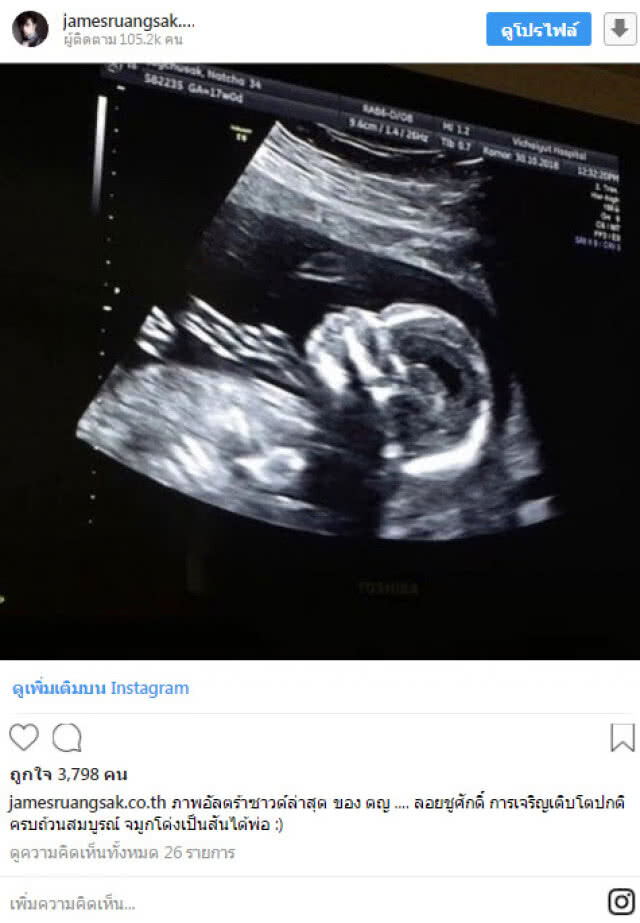 "เจมส์" เห่อสุดๆอวดภาพอัลตราซาวด์ลูกสาวบอกชัด "จมูกโด่ง...ได้พ่อ"