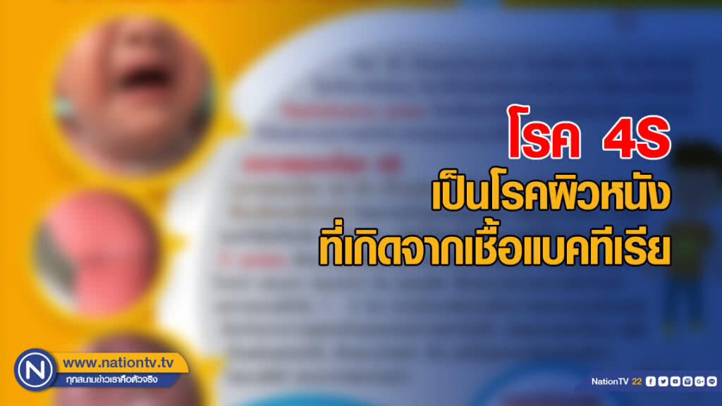 แพทย์ผิวหนัง ชี้ โรค 4S เป็นโรคผิวหนังที่เกิดจากเชื้อแบคทีเรีย