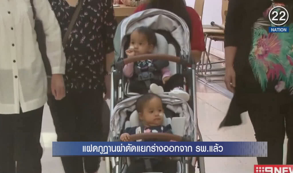 (คลิปข่าว) เด็กฝาแฝดภูฏาน ที่ผ่าตัดแยกร่างออกจาก รพ.แล้ว (คลิปข่าว) เด็กฝาแฝดภูฏาน ที่ผ่าตัดแยกร่างออกจาก รพ.แล้ว