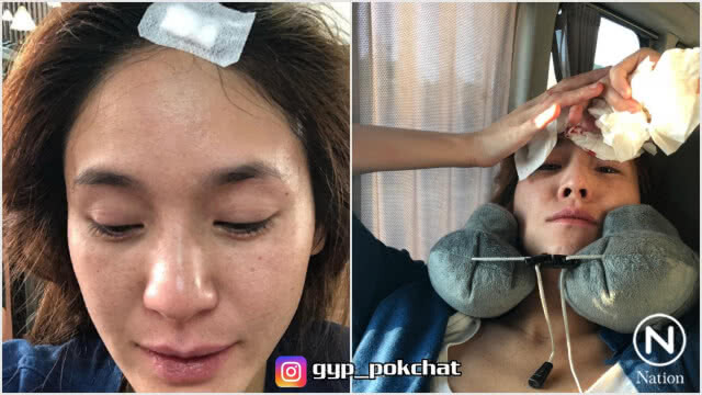 เย็บด่วน! "จิ๊บ ปกฉัตร" วูบ หวิดเสียโฉม