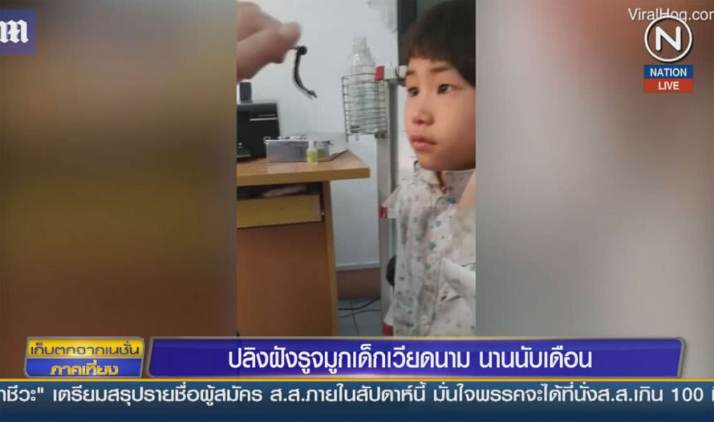 (คลิปข่าว) ปลิงฝังรูจมูกเด็กเวียดนามนานนับเดือน (คลิปข่าว) ปลิงฝังรูจมูกเด็กเวียดนามนานนับเดือน