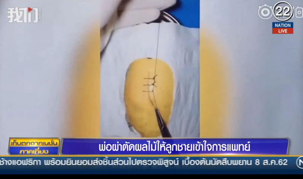 หมอจีนสอนลูกชาย นำ "ผลไม้" จำลองวิธี "ผ่าตัด"