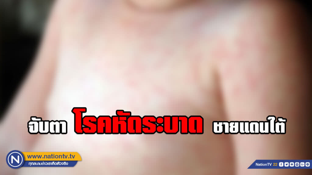 กรมวิทยาศาสตร์การแพทย์​ จับตาโรคหัดระบาดในพื้นที่ชายแดนใต้​