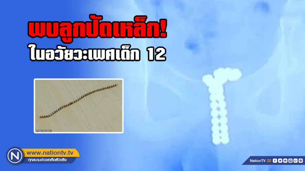 หมออึ้ง! เจอลูกปัดแม่เหล็กกว่า 40 เม็ด ในอวัยวะเพศเด็ก 12 ขวบ หมออึ้ง! เจอลูกปัดแม่เหล็กกว่า 40 เม็ด ในอวัยวะเพศเด็ก 12 ขวบ