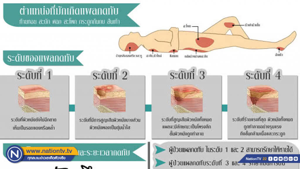 แนะผู้ป่วยติดเตียงขยับทุก​ 2​ ชั่วโมง​ ลดการเกิดแผลกดทับ