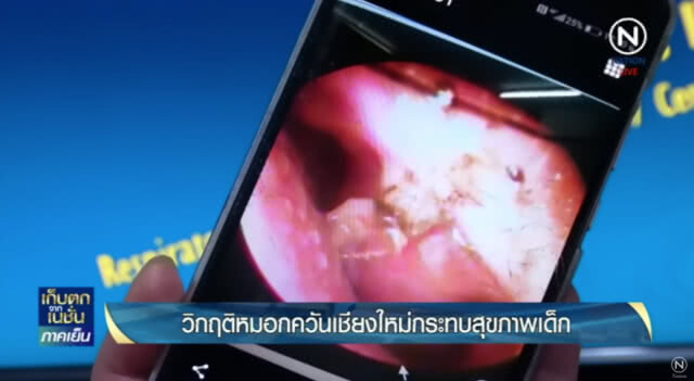 แพทย์ มช.เผยภาพ "โพรงจมูก" คนไข้ที่สูด PM2.5 เป็นเวลานาน