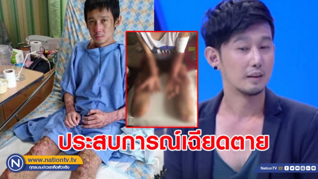 อุทาหรณ์ หนุ่มกินหลู้หมูดิบติดเชื้อในกระแสเลือดต้องตัดขาทิ้ง