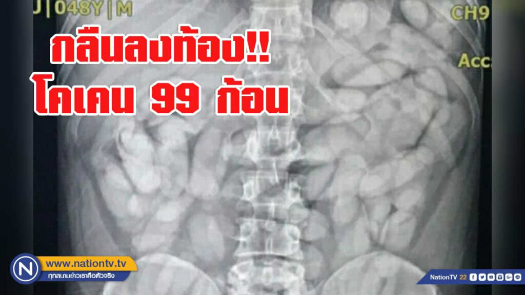 รวบหนุ่มเซเนกัล ลักลอบขนโคเคน 99 ก้อน กลืนลงท้อง!!