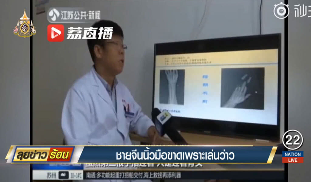 ชายจีนนิ้วมือขาดเพราะเล่นว่าว ชายจีนนิ้วมือขาดเพราะเล่นว่าว