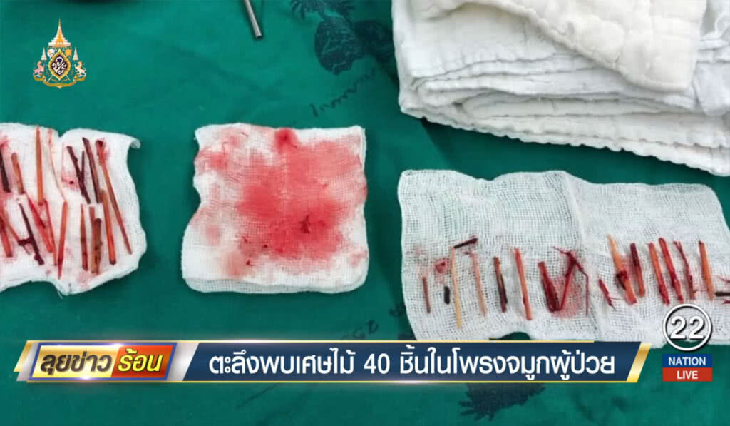 ตะลึง! พบเศษไม้ 40 ชิ้นในโพรงจมูกผู้ป่วย ตะลึง! พบเศษไม้ 40 ชิ้นในโพรงจมูกผู้ป่วย