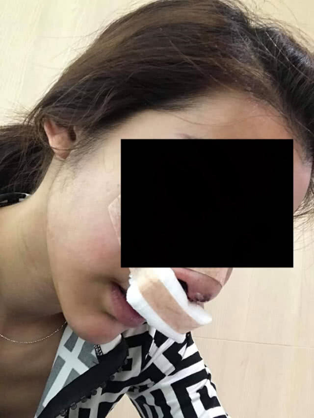 คืบหน้า กรณีหญิงถูกแฟนหนุ่มเตะต่อยหน้าจนซิลิโคนจมูกทะลุ