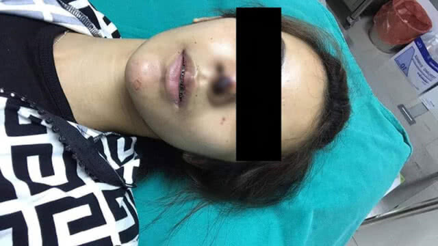 คืบหน้า กรณีหญิงถูกแฟนหนุ่มเตะต่อยหน้าจนซิลิโคนจมูกทะลุ