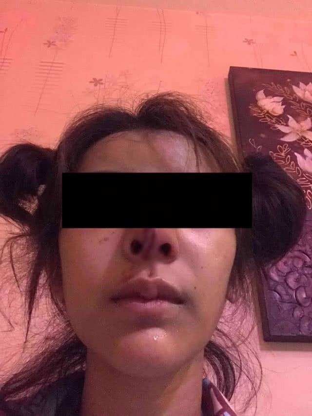 คืบหน้า กรณีหญิงถูกแฟนหนุ่มเตะต่อยหน้าจนซิลิโคนจมูกทะลุ