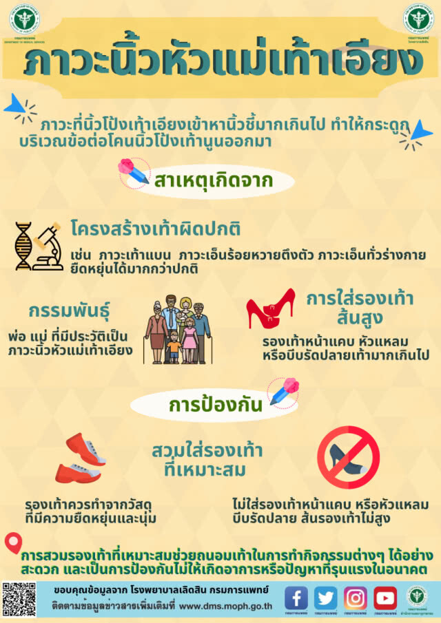 แพทย์เตือน! ใส่รองเท้าหน้าแคบ หัวแหลม ระวังภาวะนิ้วหัวแม่เท้าเอียง