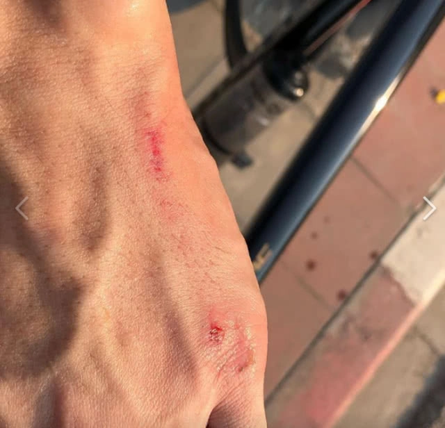 "ณัฐ เทพหัสดิน" โดนเฉี่ยว จักรยานล้ม จนเป็นแผลหมูแดงที่ก้น