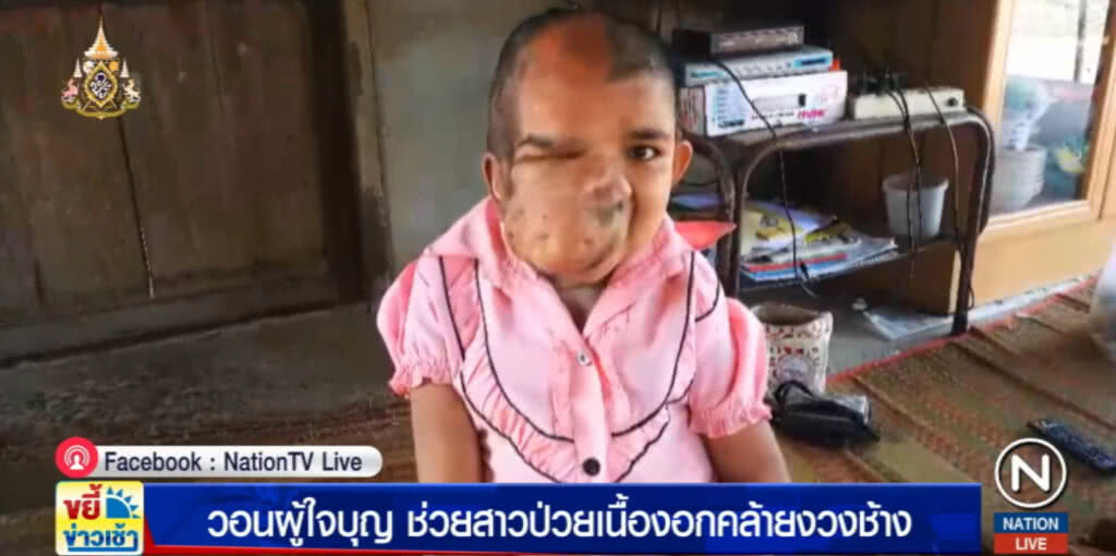 วอนผู้ใจบุญช่วยสาวป่วยเนื้องอกคล้ายงวงช้าง