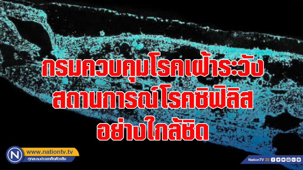 กรมควบคุมโรคเฝ้าระวังสถานการณ์โรคซิฟิลิสอย่างใกล้ชิด  หลังพบมีแนวโน้มเพิ่มสูงขึ้น