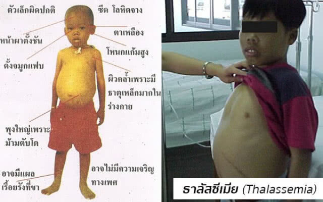 8 พฤษภาคม "วันโรคธาลัสซีเมียโลก"