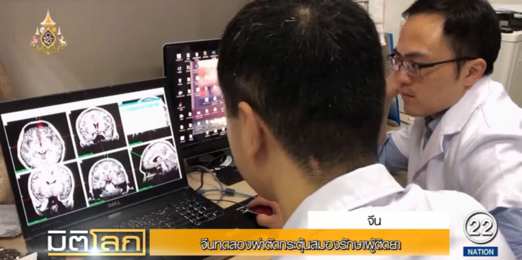 จีนทดสอบผ่าตัดกระตุ้นสมอง รักษาผู้ติดยาเสพติด