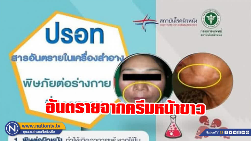 แพทย์ผิวหนังเตือนภัย! อันตรายจากครีมหน้าขาว