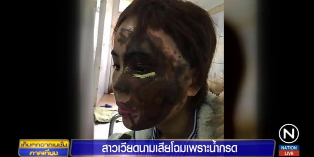 หึงโหด!.....สาวเวียดนามเสียโฉม หลังคู่หมั้นสาดน้ำกรด เหตุกลัวถูกทิ้ง