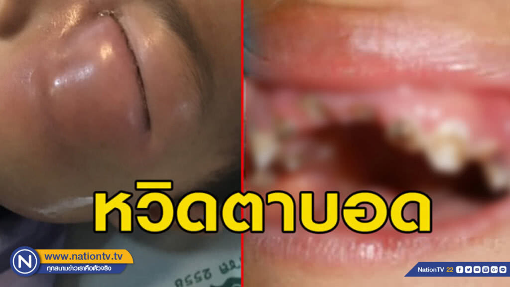หนูน้อยวัย 3 ขวบ ฟันผุติดเชื้อรุนแรง หนองขึ้นตาหวิดตาบอด หนูน้อยวัย 3 ขวบ ฟันผุติดเชื้อรุนแรง หนองขึ้นตาหวิดตาบอด