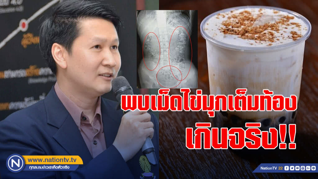อ.เจษฎา ชี้ข่าวพบเม็ดไข่มุกเต็มท้องเด็ก14 เกินจริง!!