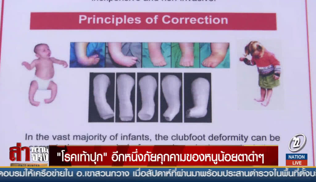 "โรคเท้าปุก" อีกหนึ่งภัยคุกคามของหนูน้อยตาดำๆ