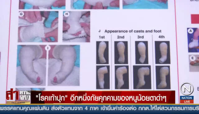 "โรคเท้าปุก" อีกหนึ่งภัยคุกคามของหนูน้อยตาดำๆ