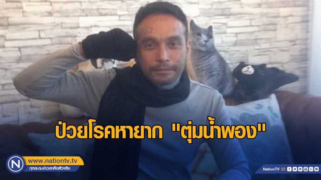 "เมฆ วินัย" รับ "เจ็บสุดในชีวิต" ป่วยโรคหายาก "ตุ่มน้ำพอง"