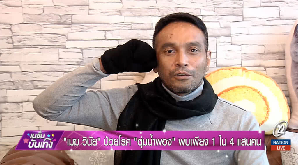 "เมฆ วินัย" ป่วยโรค "ตุ่มน้ำพอง" พบเพียง 1 ใน 4 แสนคน