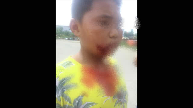 แม่เด็กโดนพิตบูลกัดผวาหนัก!! ...อยากให้นำหมาออกนอกพื้นที่