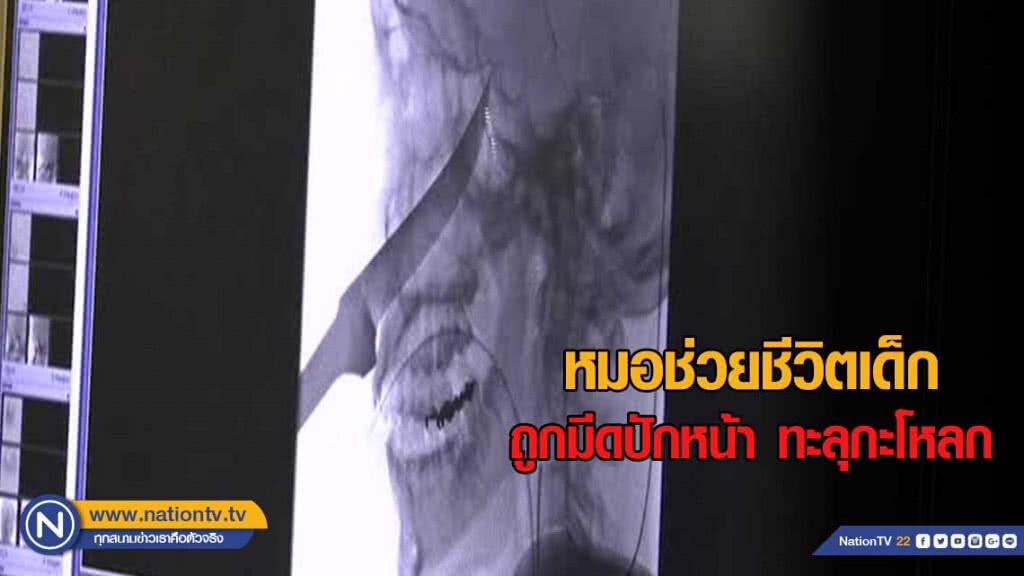 หมอช่วยชีวิตเด็กถูกมีดปักหน้า ทะลุกะโหลก