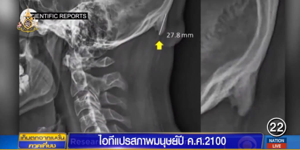 เผยมนุษย์ปี 2100 แปรสภาพ ใช้สมาร์ทโฟนมาก สมองหด มือหลังงอ!