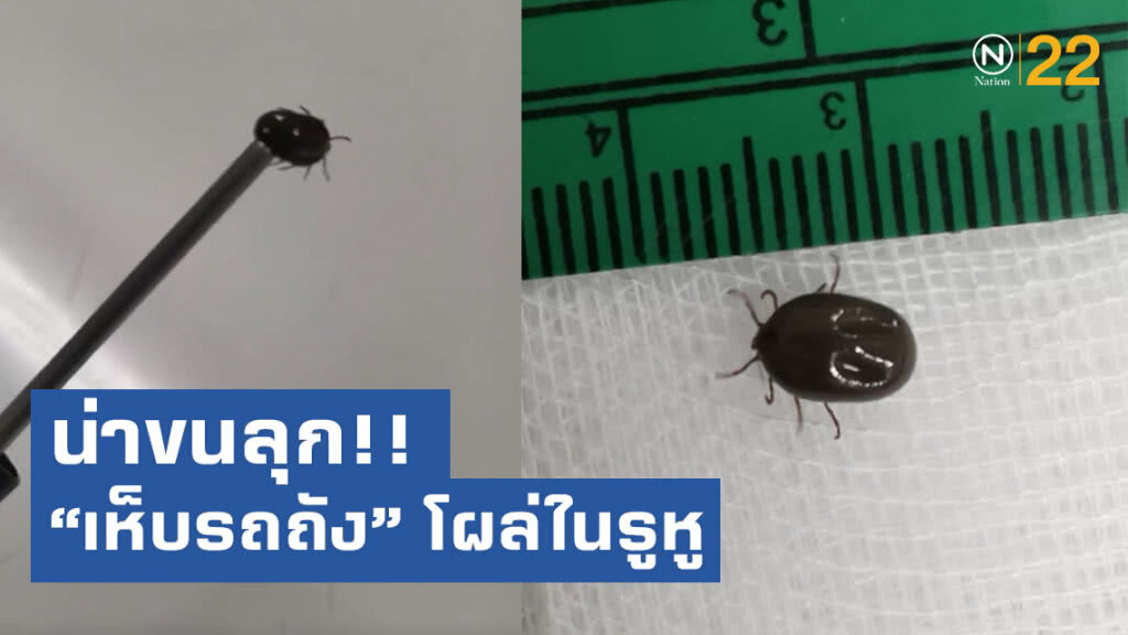 น่าขนลุก!! หมอโพสต์คลิป "เห็บรถถัง" โผล่ในรูหู ยังดิ้นดุ๊กดิ๊กอยู่เลย น่าขนลุก!! หมอโพสต์คลิป "เห็บรถถัง" โผล่ในรูหู ยังดิ้นดุ๊กดิ๊กอยู่เลย