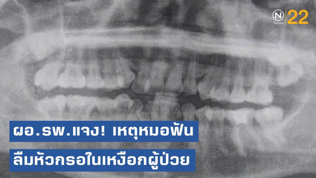 ผอ.รพ.ตากใบ แจง! เหตุหมอฟันลืมหัวกรอในเหงือกผู้ป่วย พร้อมให้ความเป็นธรรม