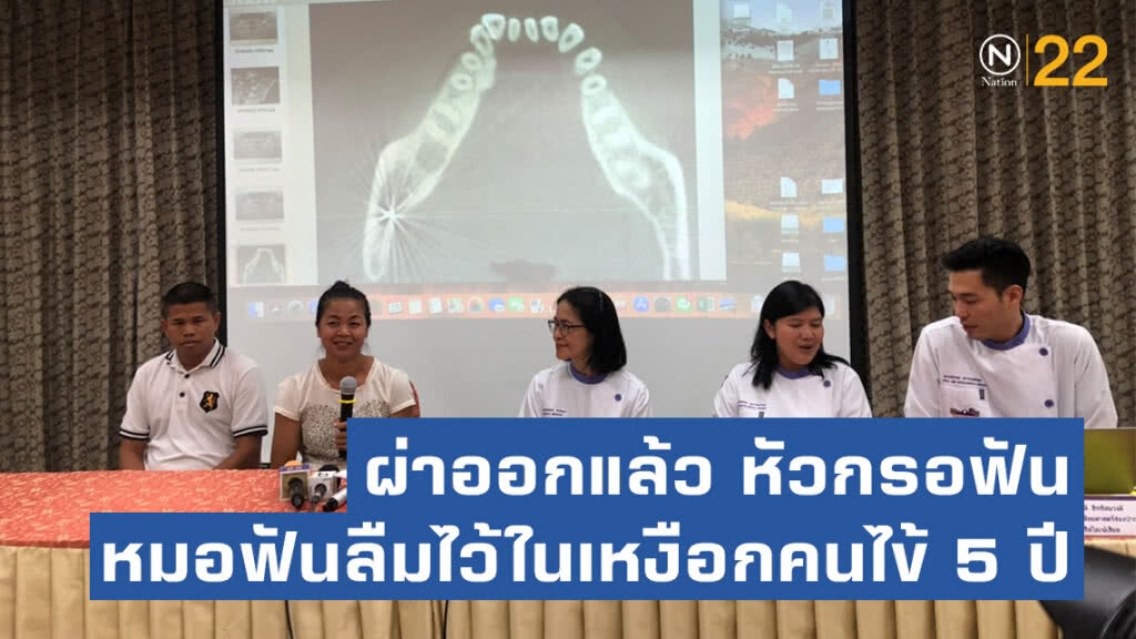 ผ่าออกแล้ว หัวกรอฟันที่ทันตแพทย์ลืมไว้ในเหงือกคนไข้ 5 ปี